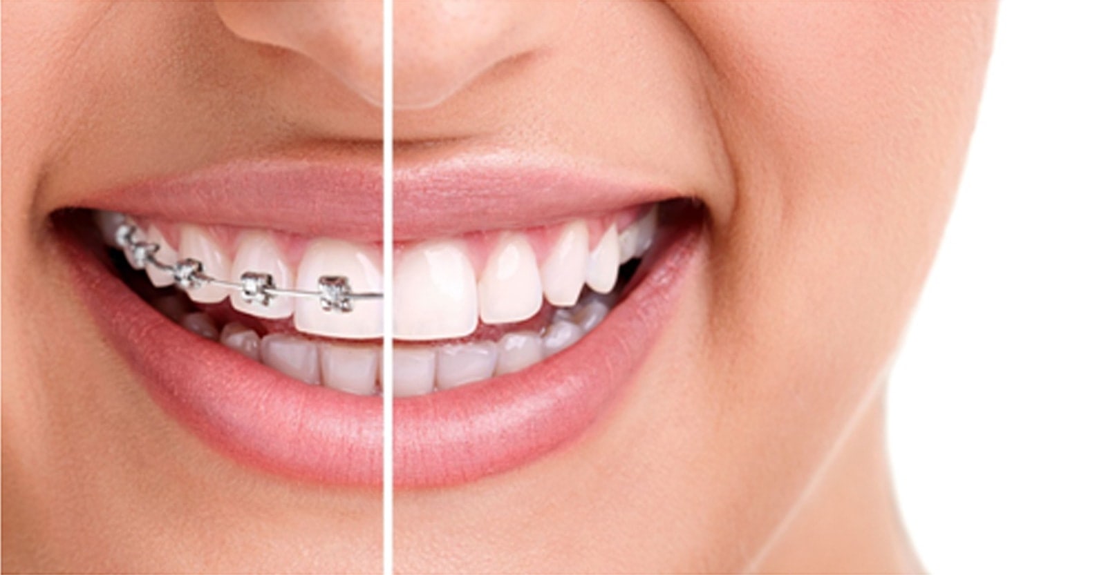 invisalign braces