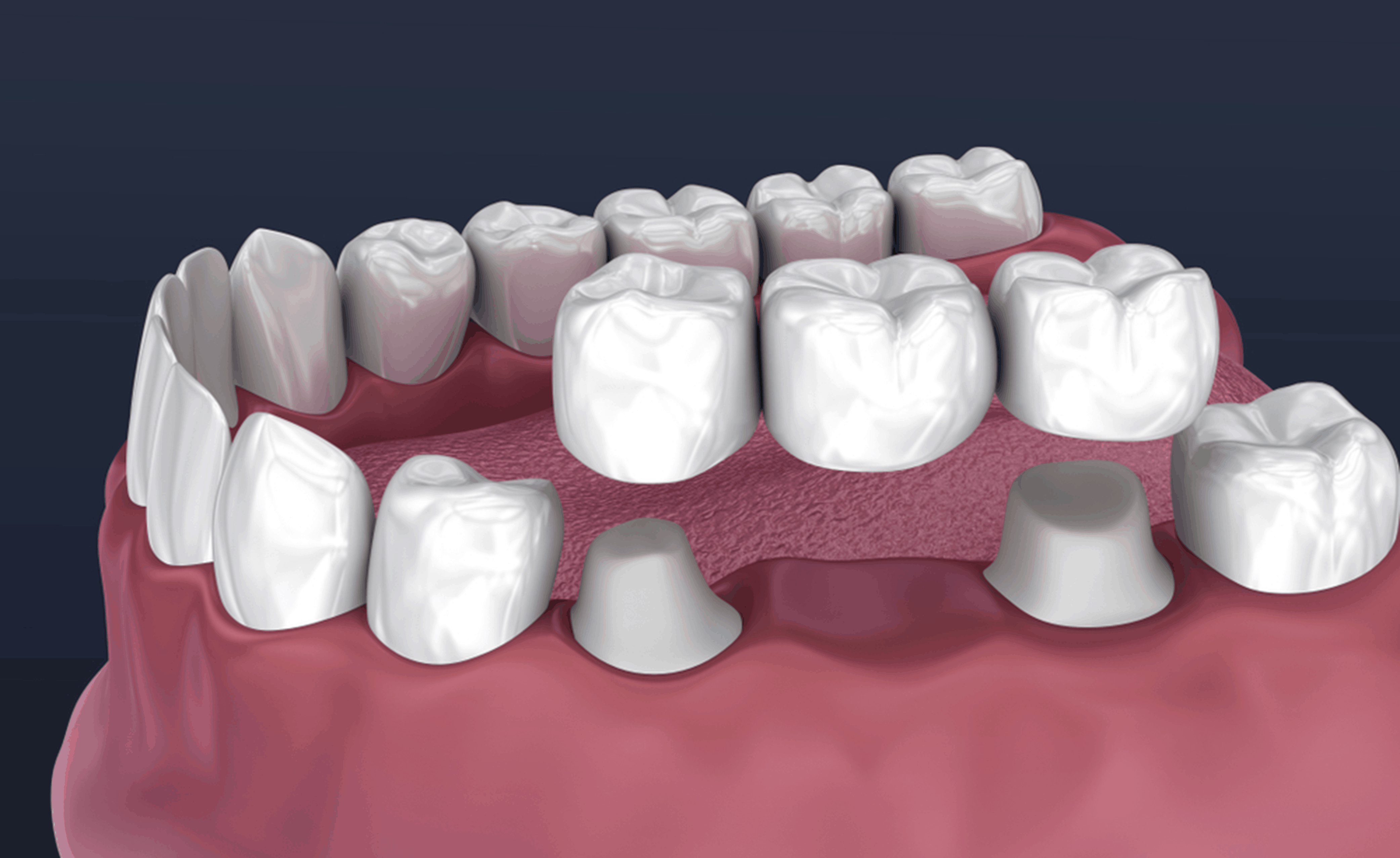 dental bridges near you