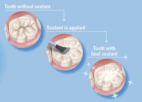 dental sealants in mckenzie towne