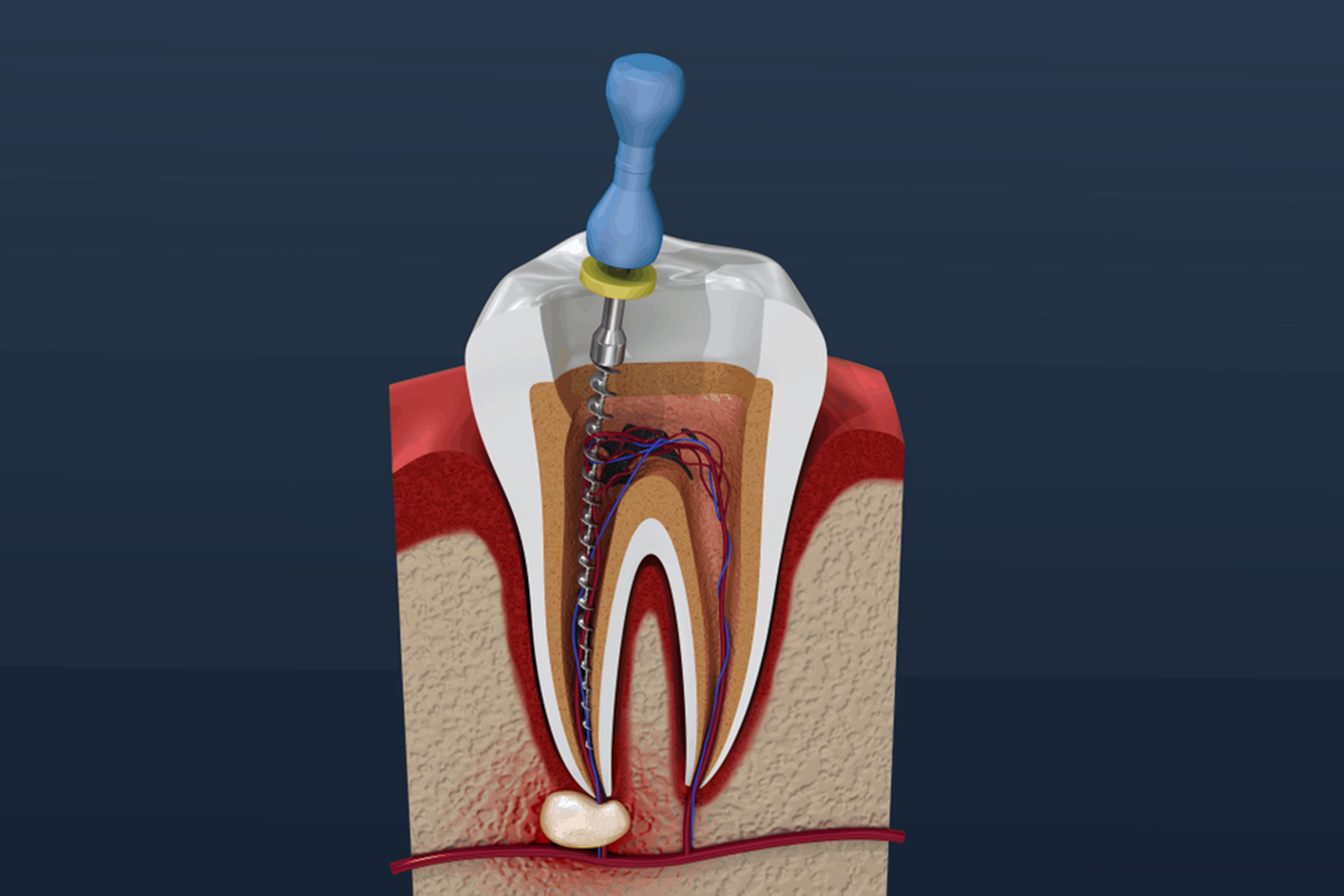 root canal treatment near you