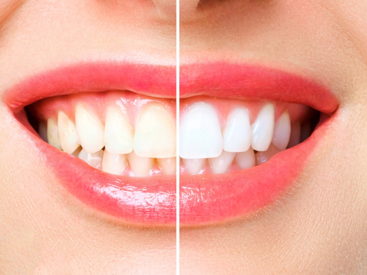 teeth whitening in mckenzie towne