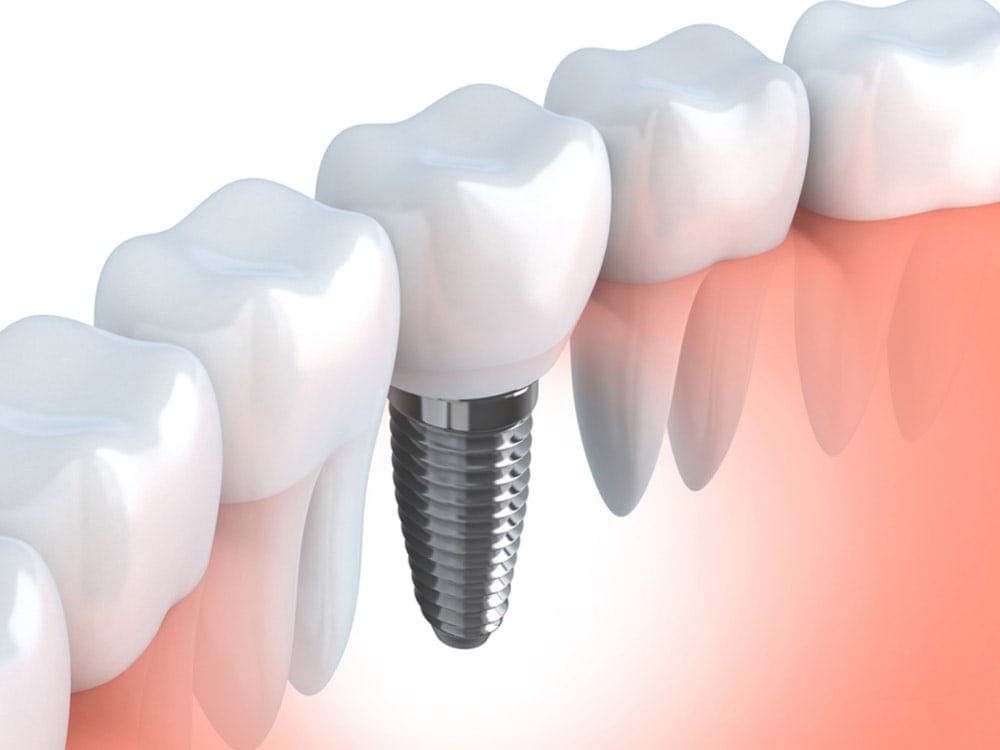 dental implants in mckenzie towne