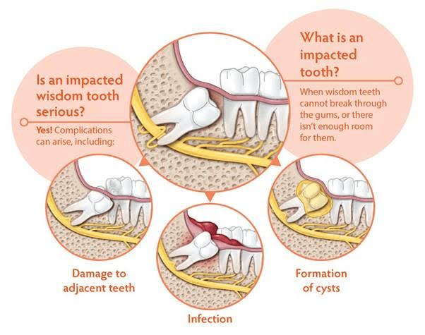remove impacted wisdom teeth