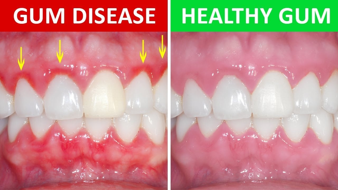 everything you need to know about gum disease