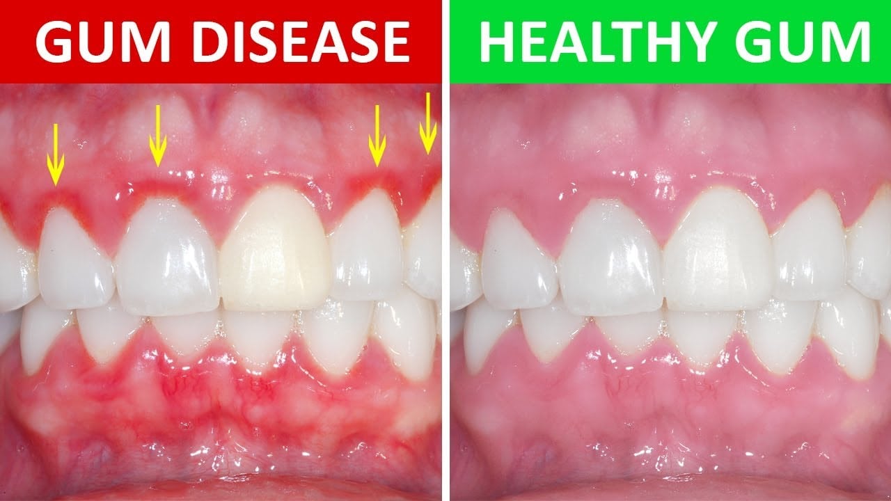 gums hurt after dentist visit