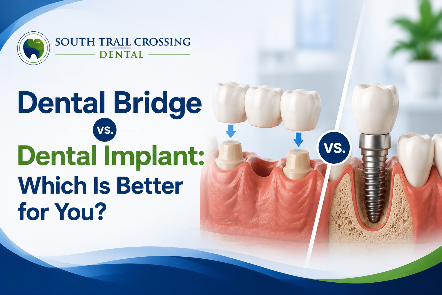 Dental Bridge vs. Dental Implant Which Is Better for You